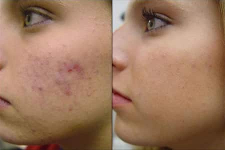 Consejos para eliminar el acne